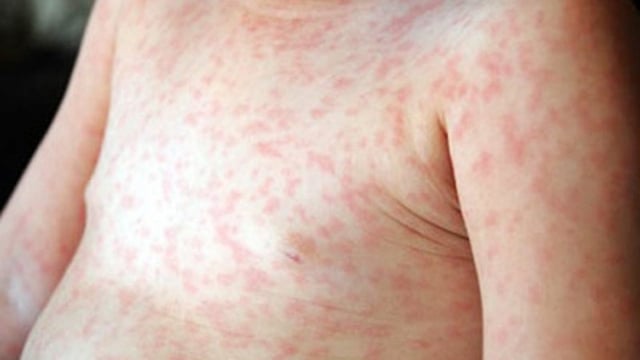 Trẻ 4 tháng bị nổi mẩn đỏ có nguy hiểm không?