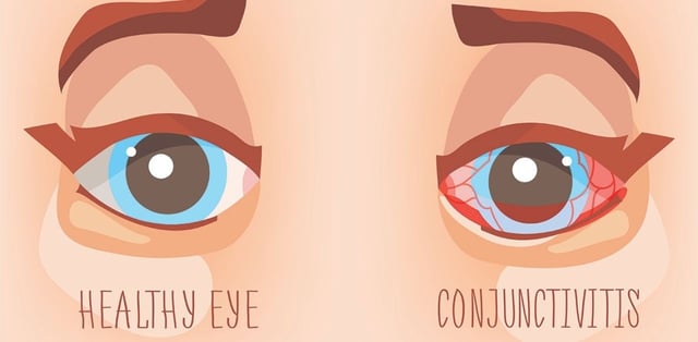Viêm kết mạc là gì và viêm kết mạc mắt có nguy hiểm không?