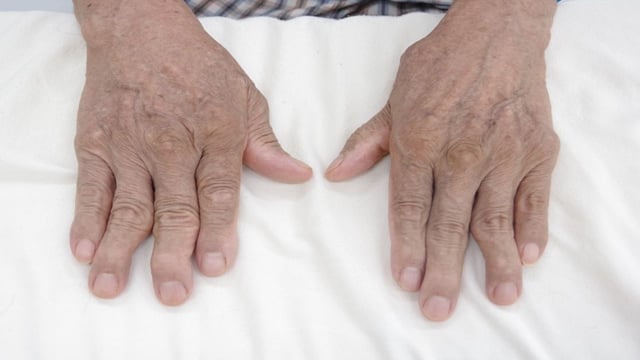 Bệnh viêm đa khớp dạng thấp chữa ở đâu tốt?