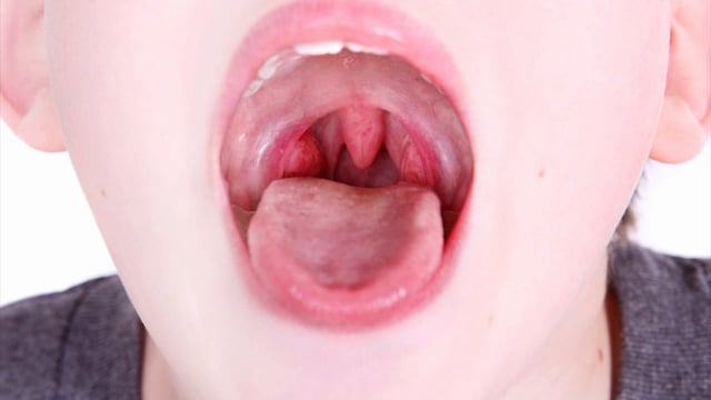 Viêm amidan mãn tính là căn bệnh gì? Nguyên nhân do đâu?