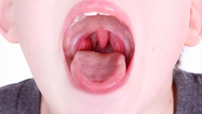 Viêm amidan mãn tính là căn bệnh gì? Nguyên nhân do đâu?