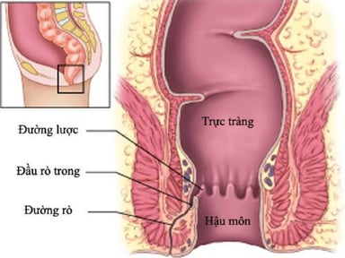 Rò hậu môn phải làm sao &#8211; Góc giải đáp