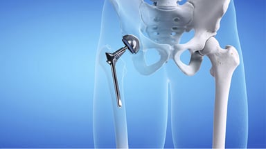 Giải đáp: Thay khớp háng bao nhiêu tiền?