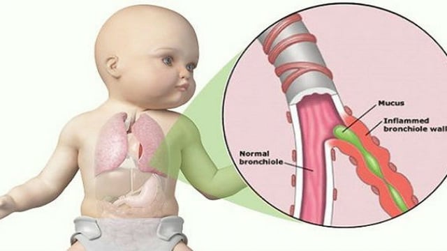 Phòng ngừa viêm phế quản cấp ở trẻ thế nào?