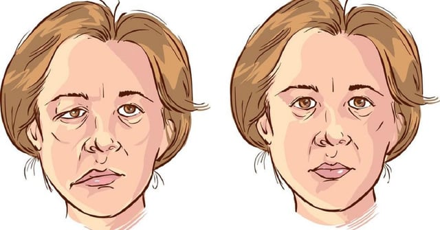 Bệnh liệt nửa mặt: nguyên nhân, triệu chứng, cách cải thiện