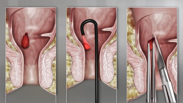 Nguyên nhân gây bệnh trĩ và cách điều trị trĩ hiện nay
