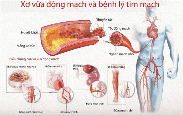 Tìm hiểu xơ vữa động mạch ở bệnh nhân đái tháo đường 