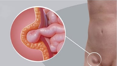 Điều trị thoát vị bẹn &#8211; thông tin cần biết