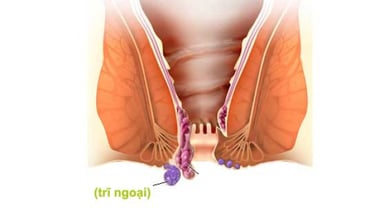 Trĩ ngoại cấp độ 1 là gì. Điều trị ra sao?