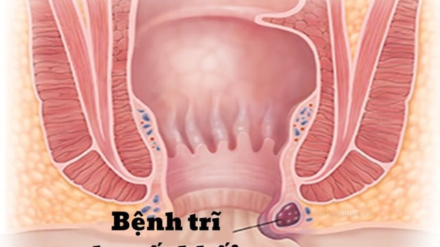 Trĩ ngoại độ 2 và những thông tin cần biết