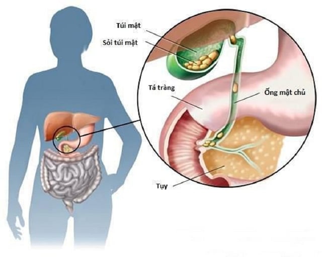 Cách điều trị bệnh sỏi mật &#8211; những  phương pháp phổ biến
