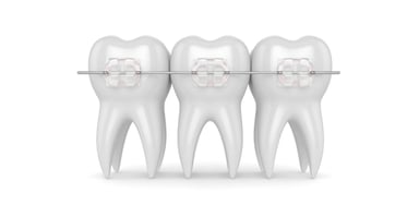 Niềng răng mắc cài sứ trong suốt &#8211; Phương pháp chỉnh nha thẩm mỹ