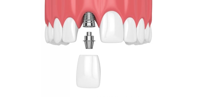Trồng răng cố định &#8211; Phục hình nha khoa hiệu quả dài lâu