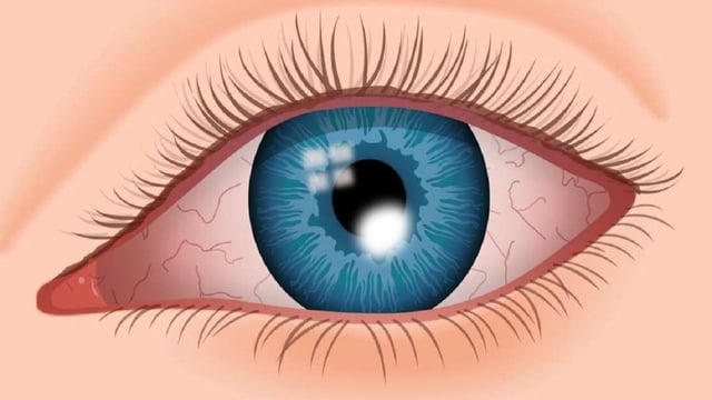 Bệnh viêm loét giác mạc là gì? Cách phòng bệnh hiệu quả