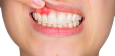 Chi phí điều trị áp xe răng có cao không?