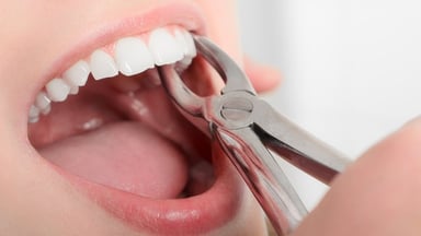 Giá nhổ răng hàm hiện nay là bao nhiêu? 