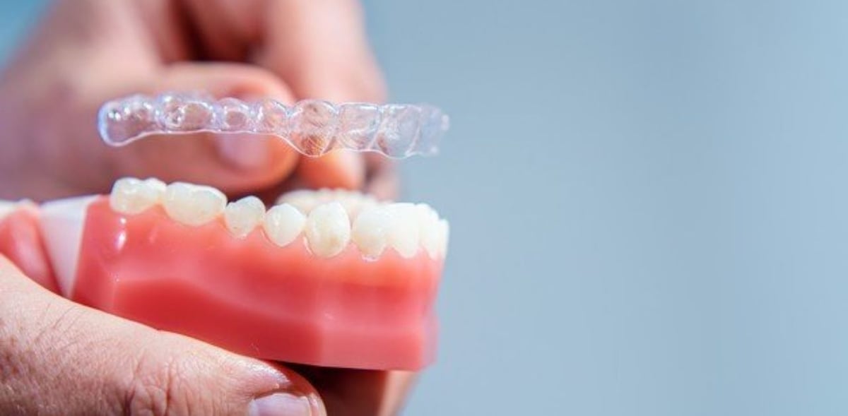 Giá niềng răng không mắc cài hiện nay cao bao nhiêu?