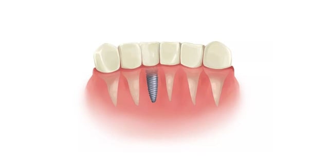 Chuyên gia giải đáp: Trồng 1 cái răng bao nhiêu tiền?