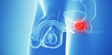 Bệnh ung thư tuyến tiền liệt có chữa được không?