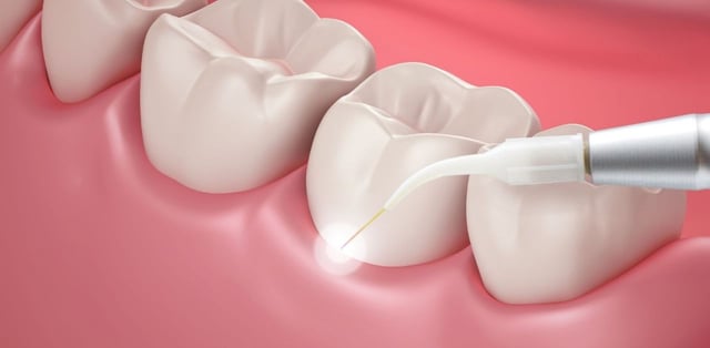 Cách chữa viêm chân răng có mủ tại nhà hữu ích nhất