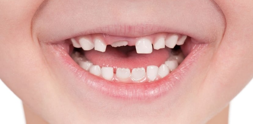 Có bao nhiêu răng sữa phải thay ở trẻ nhỏ?
