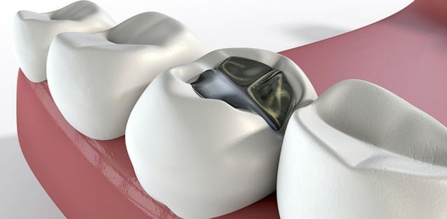 Răng hàm số 6 bị sâu: Nguyên nhân và cách điều trị