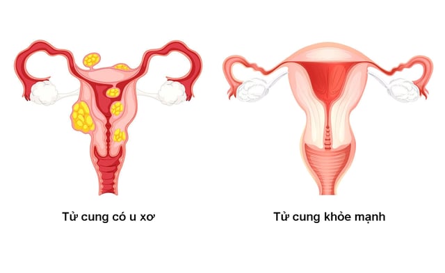 Ăn gì để hết u xơ tử cung &#8211; Mẹ bầu cần lưu ý