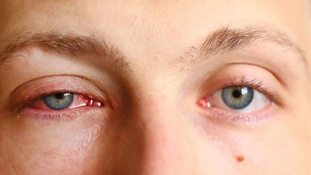 Bệnh đau mắt đỏ có lây không và cách chữa bệnh hiệu quả