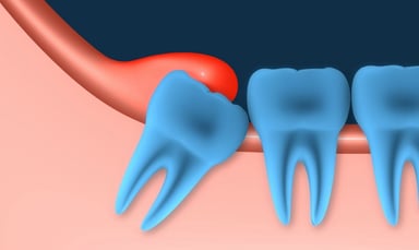 Bệnh viêm lợi trùm: Nguyên nhân và cách điều trị 