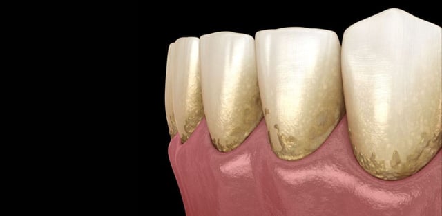 Cao răng hình thành như thế nào, có hại không?