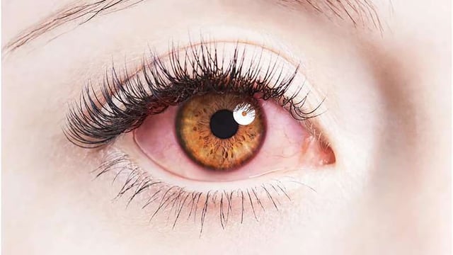 Bệnh đau mắt đỏ có nguy hiểm không? Điều trị thế nào?