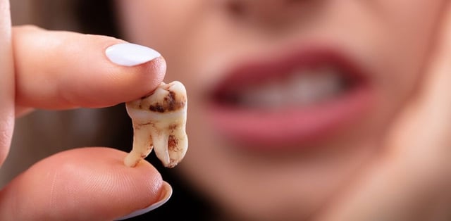 Tìm hiểu cách chữa sâu răng dứt điểm