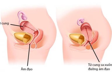 Đẻ mổ có bị sa tử cung không? Cách phòng tránh ra sao?