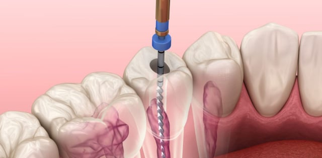 Giải đáp: Điều trị tủy răng là gì?