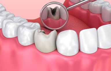 GIẢI ĐÁP: Khi nào nên nhổ răng sâu?