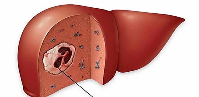 U gan nguyên bào &#8211; u gan ác tính ở trẻ em