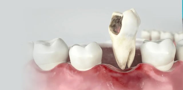 Bọc răng sứ bị viêm lợi: Nguyên nhân và cách điều trị