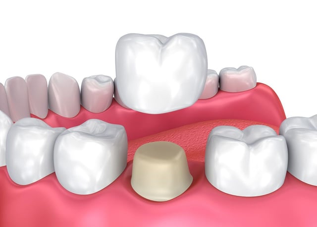 Chuyên gia giải đáp: Có bao nhiêu loại răng sứ?