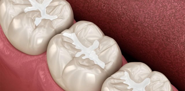 Hàn răng là gì, quy trình thực hiện như thế nào?
