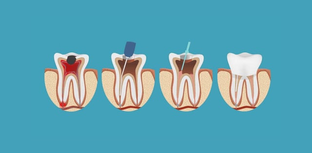 Khi nào cần điều trị tủy răng triệt để?