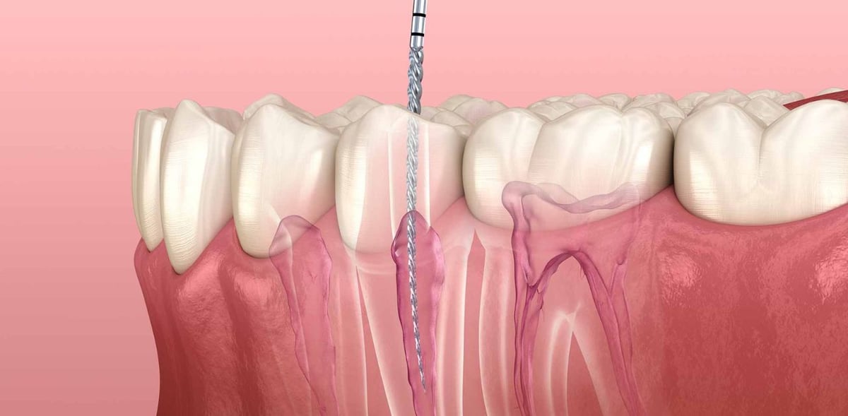 Những vấn đề cần lưu ý khi điều trị tủy răng