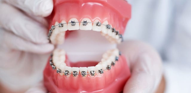 Viêm lợi khi niềng răng: Nguyên nhân và cách điều trị