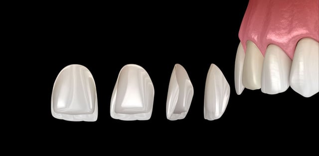 Giải đáp: Có nên dán sứ veneer không?