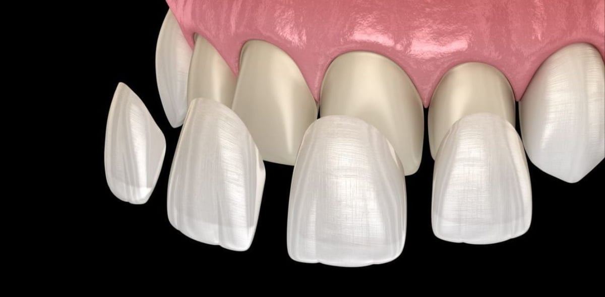 Tìm hiểu phương pháp dán răng sứ veneer là gì?