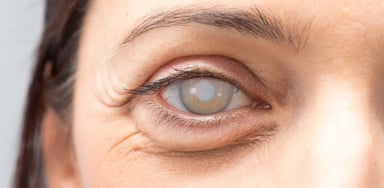 Đục thủy tinh thể độ 3 &#8211; Nhận biết và điều trị đúng cách