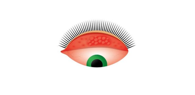 Bệnh đau mắt hột có lây không, điều trị như thế nào?