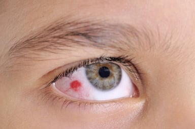 Chuyên gia giải đáp: Rách giác mạc có nguy hiểm không?