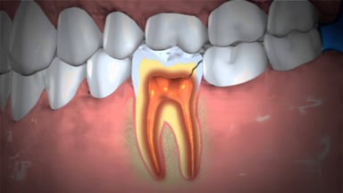 Răng viêm quanh cuống có nguy hiểm không?