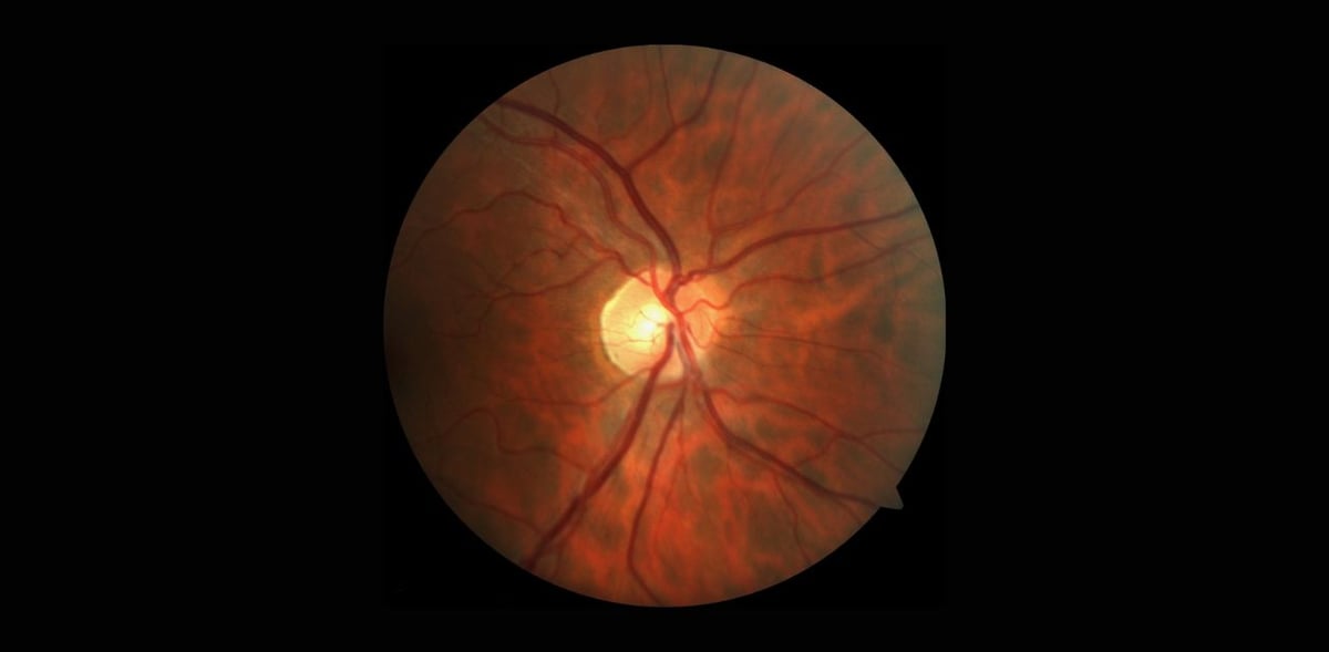 Viêm dây thần kinh thị giác: Nguyên nhân, dấu hiệu, cách điều trị