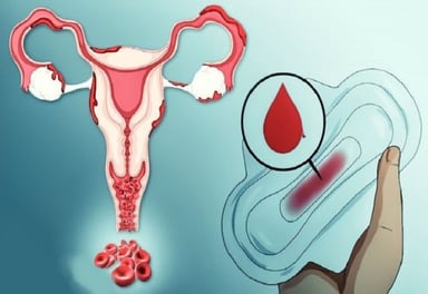 Bị rong kinh dài ngày, chị em chớ coi thường!